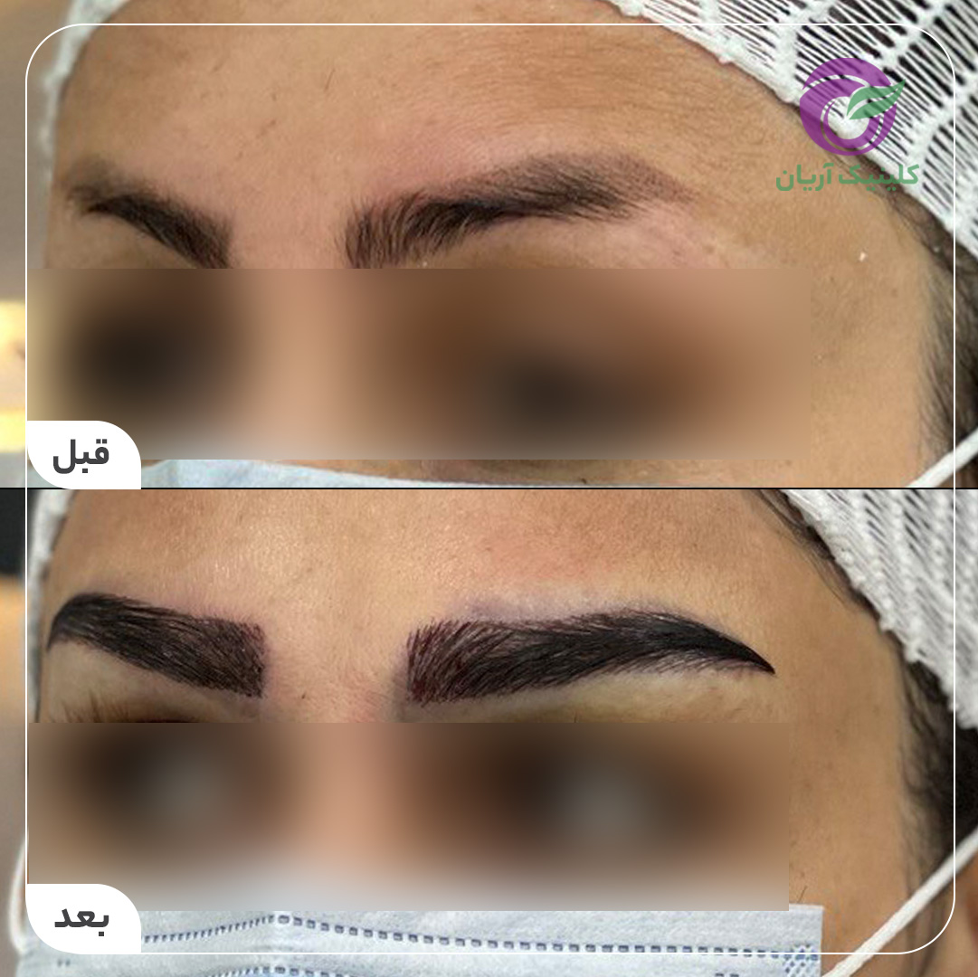 گالری فیلم کاشت ابرو